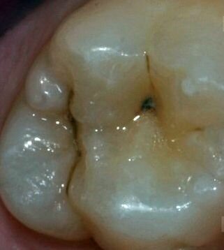 Зуб до лечения с помощью потоково-абразивной системы